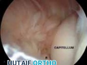 Illustration 4 for Unlock Relief: Arthroscopic Treatment of Epicondylitis Explained