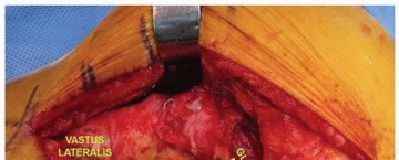 Illustration 9 for Extended Trochanteric Osteotomy: How et al Extended Revision THA Solutions