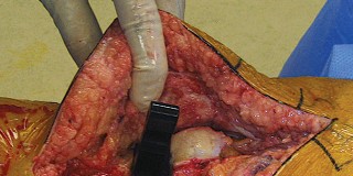 Illustration 39 for Hinged Total Knee: The Salvage Solution for Challenging Cases