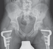 Illustration 33 for Increased Femoral Anteversion: A Proximal Femoral Rotational Osteotomy