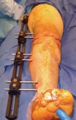 Illustration 14 for Knee Arthrodesis: A Lifelong Knee Solution for Trauma & TKA