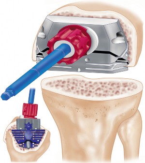 Illustration 13 for The Principles of Revision TKR: Avoid Pitfalls, Ensure Success