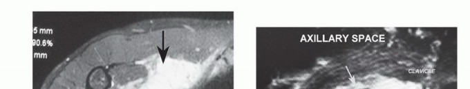 Illustration 5 for Axillary Space Exploration: Surgical Resection of Complex Tumors