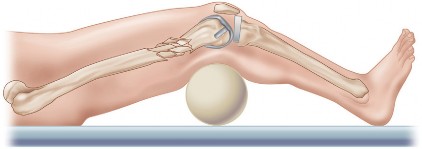 Illustration 13 for Mastering Periprosthetic Femoral Fractures Above Knee Arthroplasty