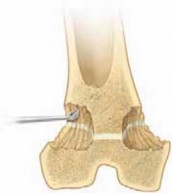 Illustration 8 for Percutaneous Epiphysiodesis: Precisely Closing the Third of the Physis