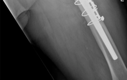Illustration 10 for Revision THA: Unlocking Stability with Porous Tantalum Cups