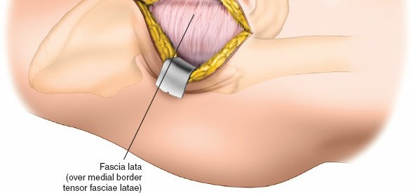 Illustration 84 for Unlocking Every Aspect of the Hip's Surgical Approaches