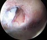 Illustration 11 for Capsular Releases for Loss of Motion: Restore Your Shoulder