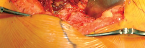 Illustration 50 for Direct Lateral Hip: Optimize Exposure with Sharp Curved Hohmann