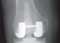 Illustration 37 for PROSTALAC Articulating Spacer: Treat Infected Knees, Regain Mobility
