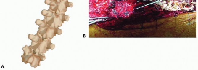 Column Resection for Severe Deformity: The All-Posterior Approach