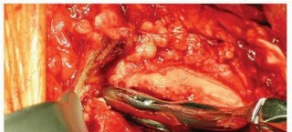 Illustration 10 for Why Polished Tapered Cemented Stems Excel in Hip Replacement
