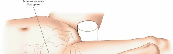 Illustration 70 for Optimal Femoral Approaches: Mastering the Lateral Intermuscular Septum