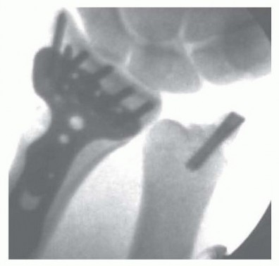 Illustration 17 for Arthroscopic Fixation: Effectively Treating Radial Styloid Fragments