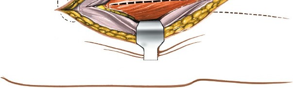 Illustration 8 for Optimal Femoral Approaches: Mastering the Lateral Intermuscular Septum