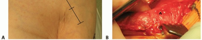 Illustration 12 for Hemiarthroplasty for Proximal: Effective Treatment for Fractures