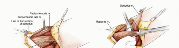 Illustration 10 for Mastering Hip Disarticulation: Through the Hip Joint Capsule