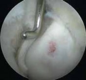 Illustration 34 for Precision Arthroscopy for Chondral Injuries & OCD: Direct Lateral Portal