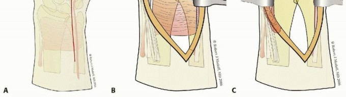 Illustration 23 for Fragment-Specific Fixation: Restore Carpal Facet Horizon