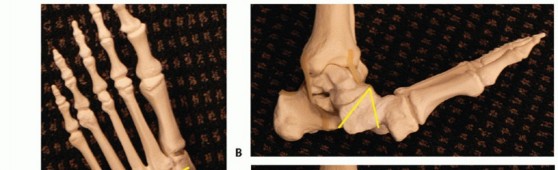 Illustration 14 for Regain Mobility: Surgical Solutions for Charcot Foot Arthropathy