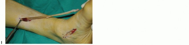 Illustration 30 for Restore Movement: Tendon Transfer for Common Peroneal Nerve Foot Drop