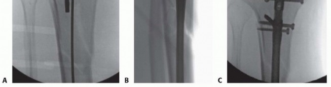 Illustration 43 for Optimizing Intramedullary Nailing for Tibial Shaft Fractures