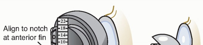 Illustration 22 for Hemiarthroplasty for Proximal: Effective Treatment for Fractures