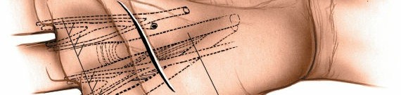 Illustration 222 for Essential Surgical Approaches: Uncover Every Aspect of the Wrist