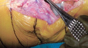 Illustration 24 for Minimally Invasive Subvastus: The Best Path to Quicker TKA Recovery