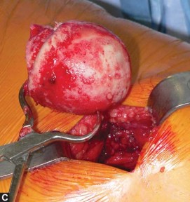 Illustration 20 for Exploring the Ambulatory Surgical Setting for Total Hip Replacement