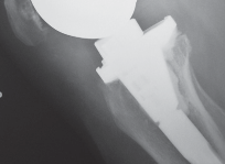 Illustration 75 for Mastering Gap Balancing in Revision TKA: Avoid Common Pitfalls