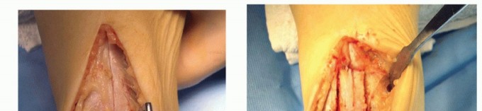 Anterior Tibial Osteotomy: Stable Fix for Osteochondral Lesions