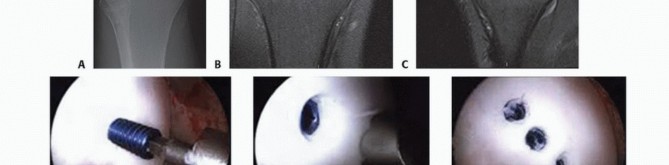 Illustration 30 for Dissecans of the Knee: What's the Difference – OCD vs. AVN?