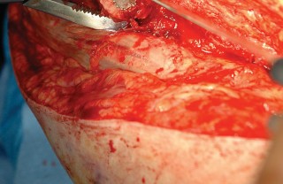 Illustration 84 for Femoral Stem Revision: Posterior Approach for Better Outcomes