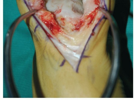 Illustration 27 for Unlock Healing: Medial Malleolar Osteotomy for Talus OLT Allografts