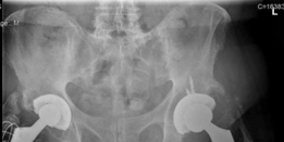 Acetabular Revision: Solving Challenges Post Two-Stage Arthroplasty