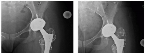 Illustration 25 for Extended Trochanteric Osteotomy: How et al Extended Revision THA Solutions