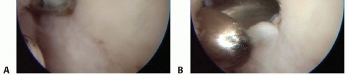 Illustration 7 for Restore Damaged Cartilage with Autologous Chondrocyte Transplantation