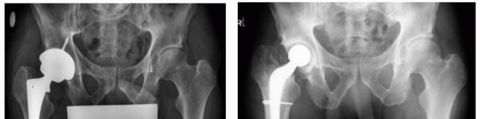 Illustration 13 for PJI of the Hip: Two-Stage Revision: When & How to Prepare