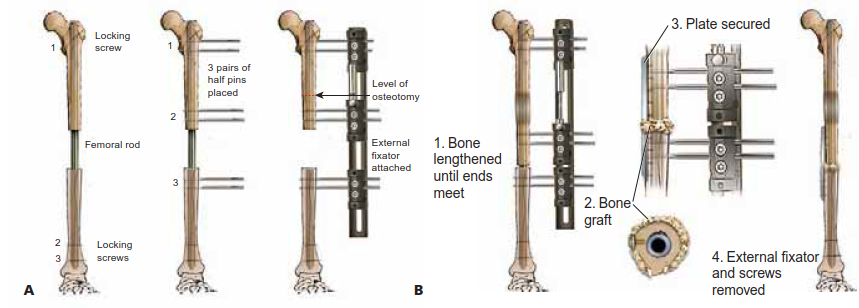 Illustration 16 for Knee Arthrodesis: A Lifelong Knee Solution for Trauma & TKA