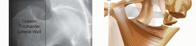 Illustration 2 for Achieve Optimal Femoral Head Fixation with Cephalomedullary Nailing