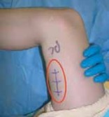 Illustration 13 for Unlocking Mobility: Distal Lengthening for Lateral Hamstring Muscle