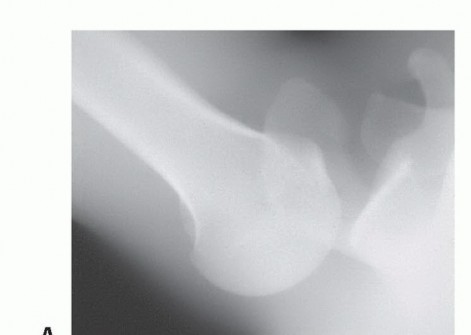 Illustration 2 for Mastering the Treatment of Recurrent Posterior Shoulder Instability