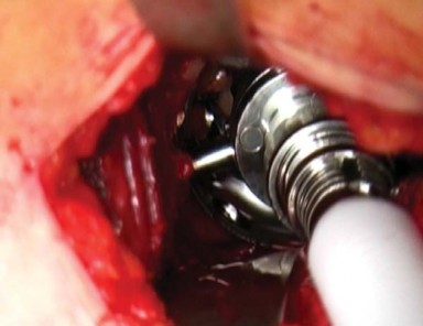 Illustration 12 for Mastering the Anterolateral Approach in Minimally Invasive Hip Replacement
