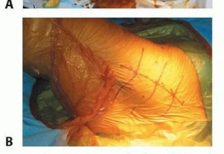 Illustration 23 for Hemiarthroplasty of the Hip: Indications & Types Explained