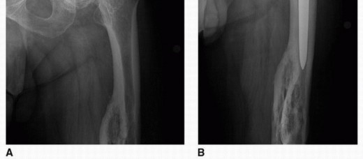 Illustration 12 for Overcoming Proximal Femoral Deformity in THA: Key Strategies