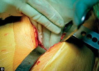 Illustration 20 for Optimizing Acetabular Component Cementation for Superior Outcomes