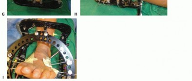 Illustration 66 for Mastering Midfoot Arthrodesis: Protect the Deep Neurovascular Bundle