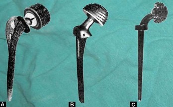 Illustration 39 for Mastering Hip Arthroplasty: Its Evolution and Design Unveiled