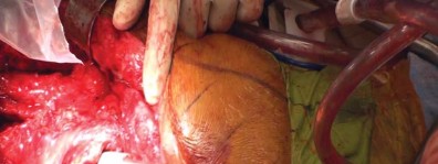 Illustration 39 for THA for patients with proximal femoral deformity: Practical solutions